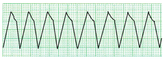 多形性心室頻拍の症状