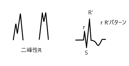 右脚ブロック 左脚ブロックとは 心電図の達人