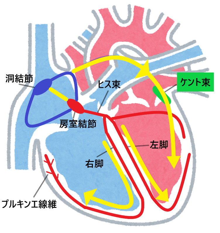 WPW症候群の心電図の特徴｜A型、B型、C型の違いとは？WPW症候群の心電図の特徴｜A型、B型、C型の違いとは？